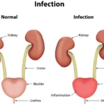 Urinary