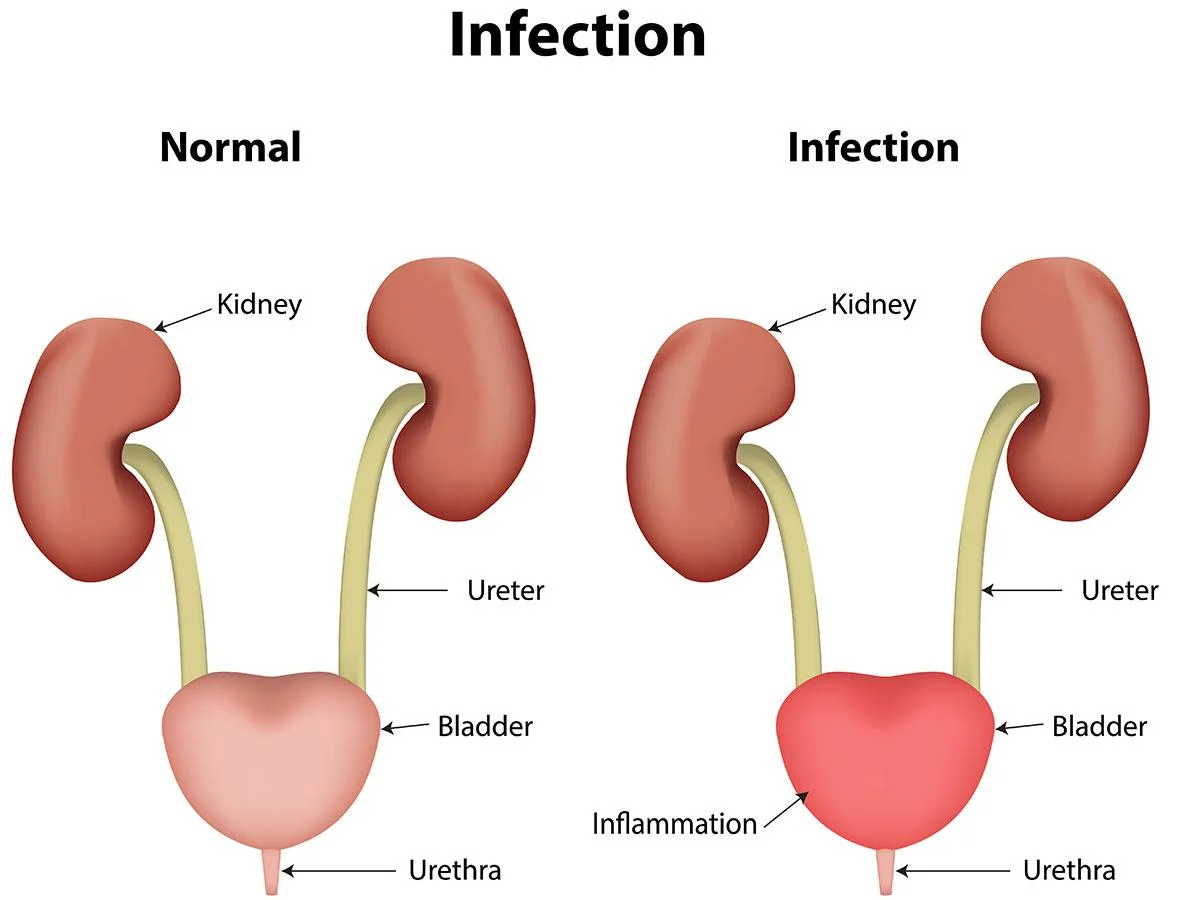 Urinary